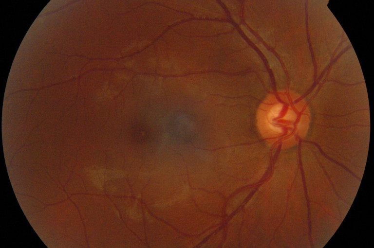 retina of the eye